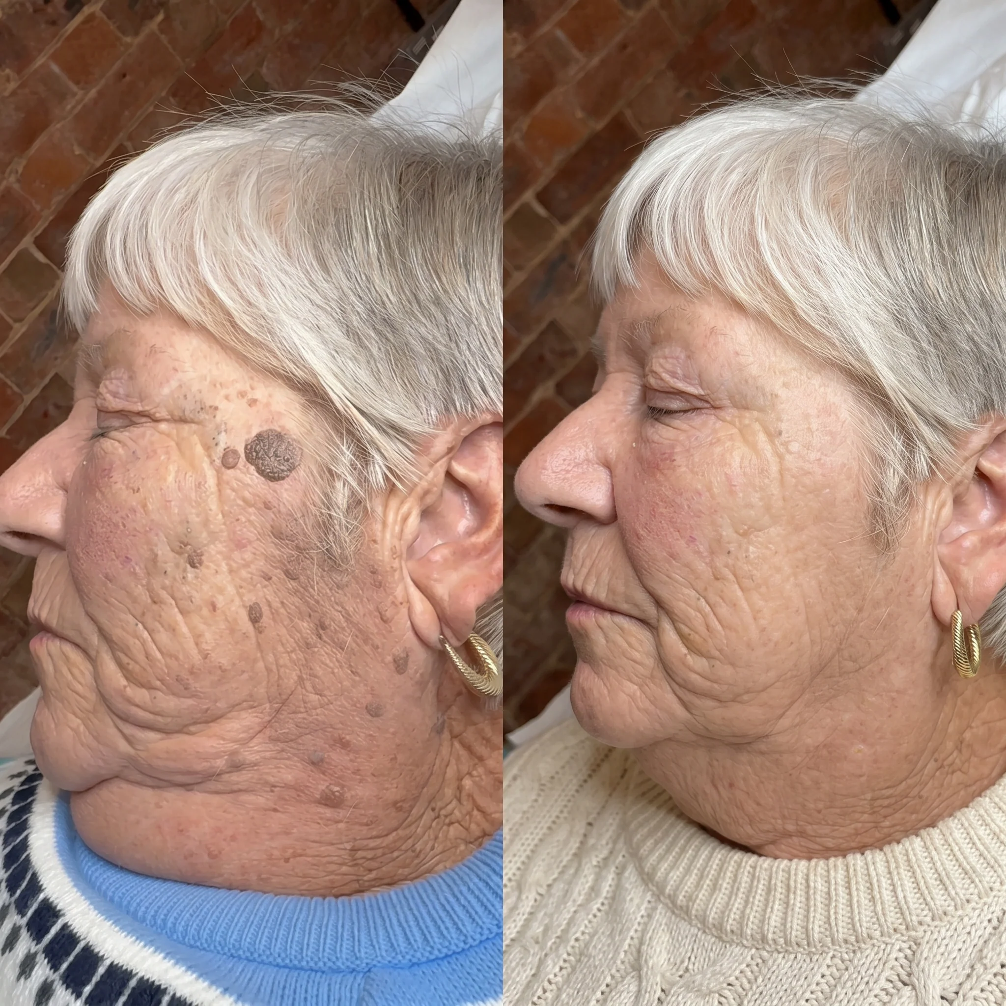 Olilos customer facial skin result