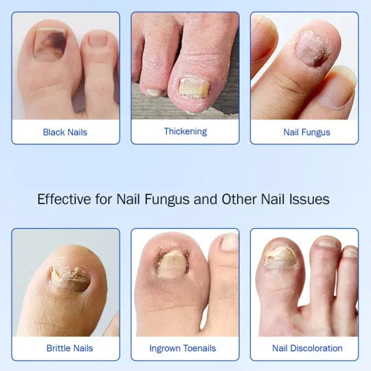 Fungal Nail Por Solving Fungal Nails anms, Nail Supplies, Daily Care Nails Kit Set-fb
